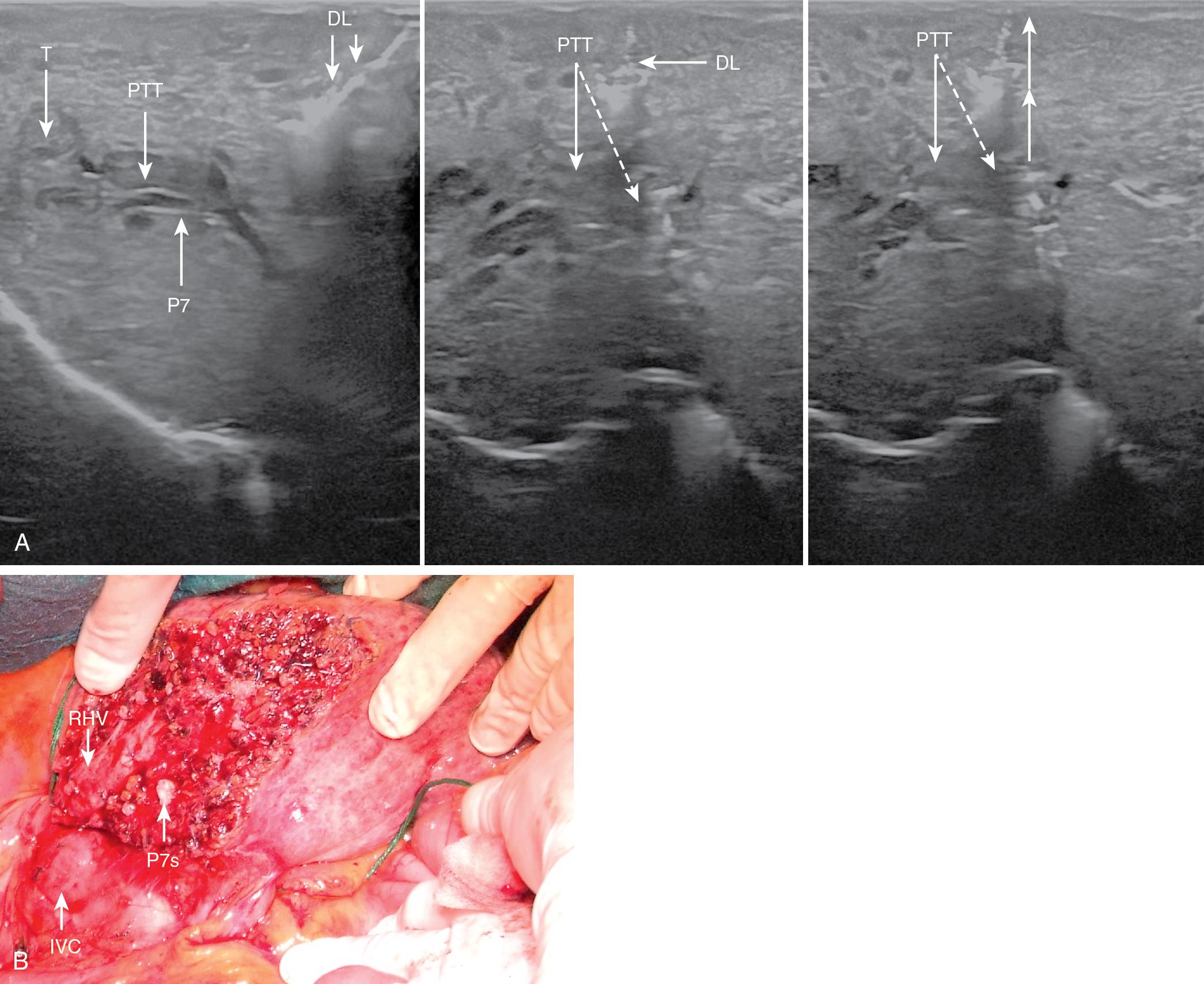 FIGURE 103.38, A, From left to tight, a tumor thrombus (PTT) in the portal branch to segment VII (P7) is visualized at intraoperative ultrasound (IOUS) and progressively reached through the dissection line (DL) ; once P7 has been achieved and encircled with suture, it is pulled up and the level of the encirclement with respect to the PTT is confirmed by the traction (dashed arrows). B, Once the integrity of the PTT is confirmed by the previously shown hooking maneuver, the resection is carried out and at the end the cut surface shows the full exposure of the right hepatic vein (RHV) and the stump of P7 (P7s). IVC , Inferior vena cava; T, tumor.
