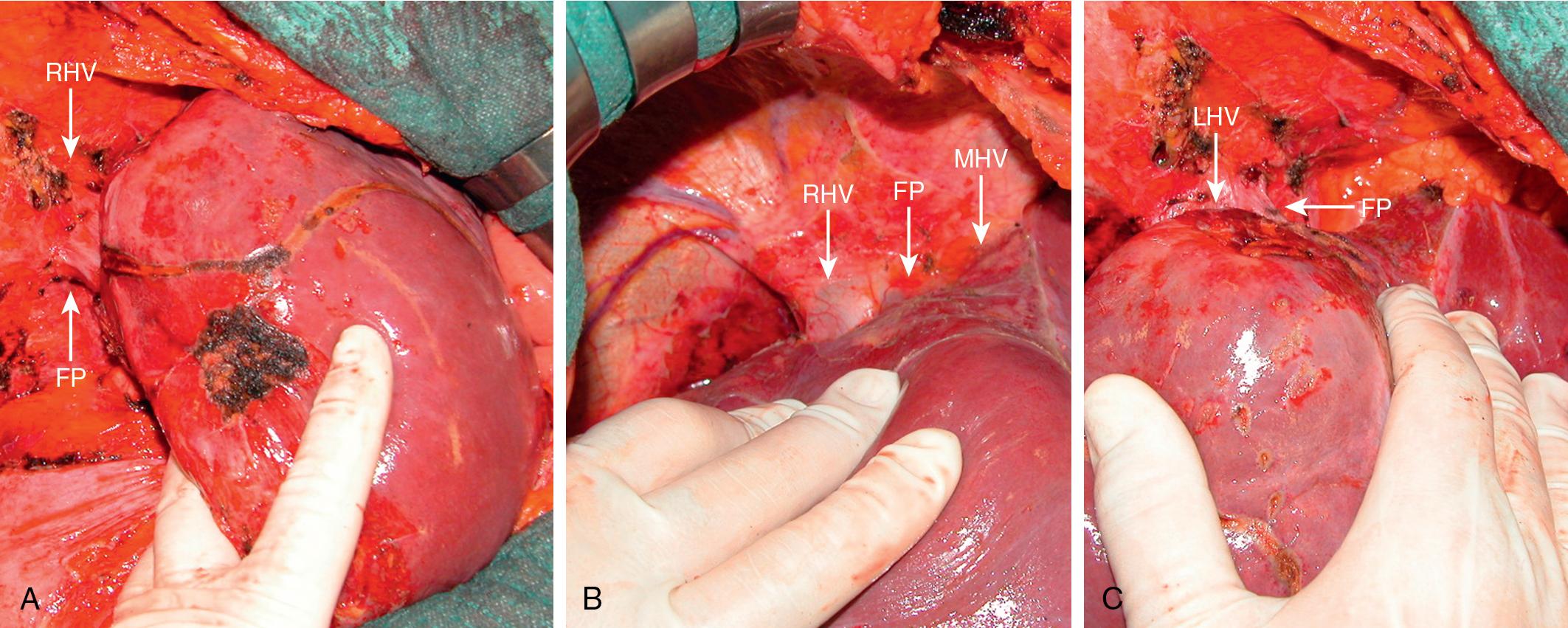 FIGURE 103.39, From left to right, the hepatocaval confluence preparation for intraoperative ultrasound–guided compression maneuvers on the right hepatic vein (RHV), the middle hepatic vein (MHV), and the left hepatic vein (LHV). FP , Fingertip position.