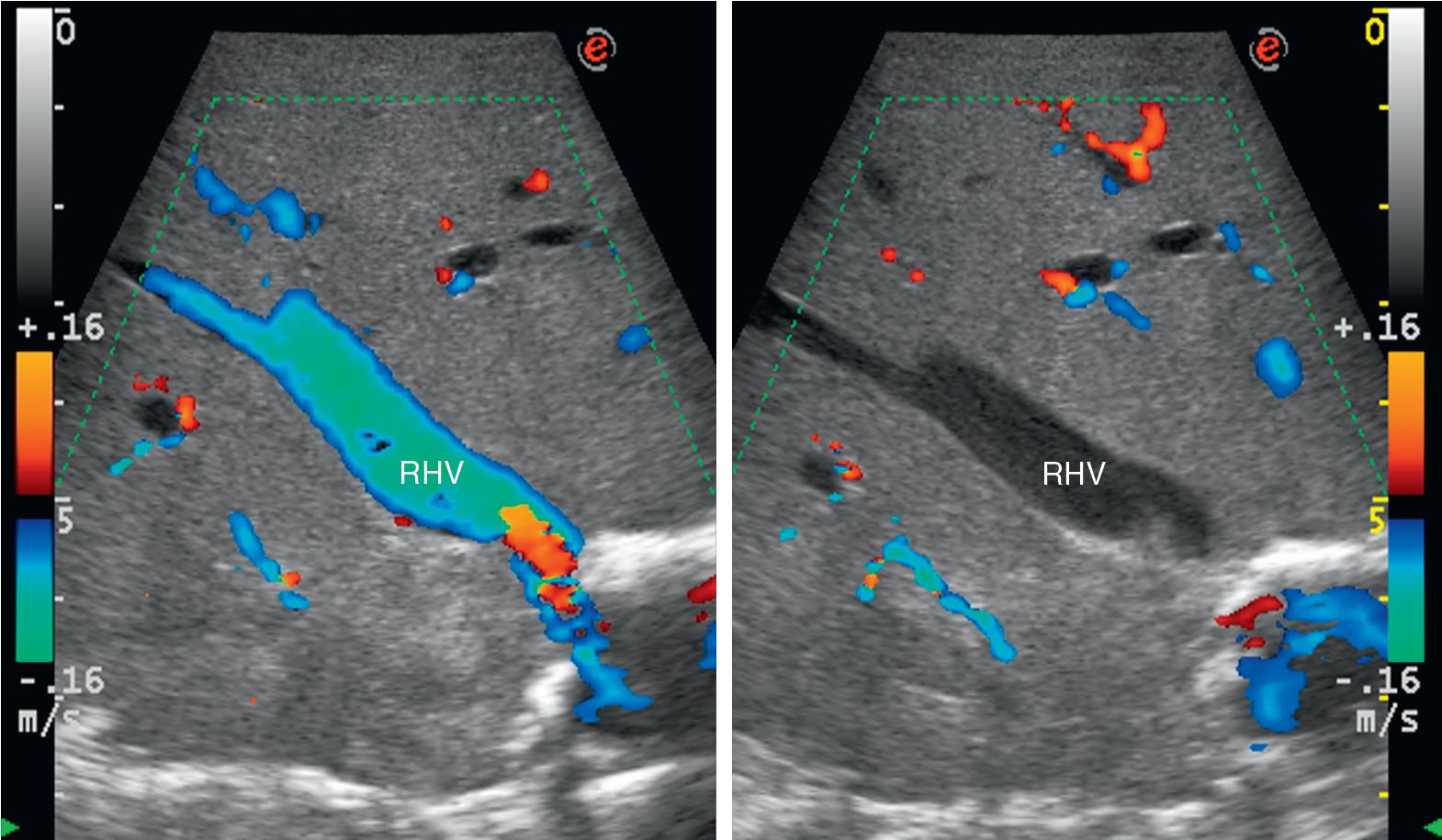 FIGURE 103.40, Once the vein, in this case the right hepatic vein (RHV), to be compressed is visualized at color-flow intraoperative ultrasound (IOUS), the compression results in the disappearance of the color flow inside the compressed vein.