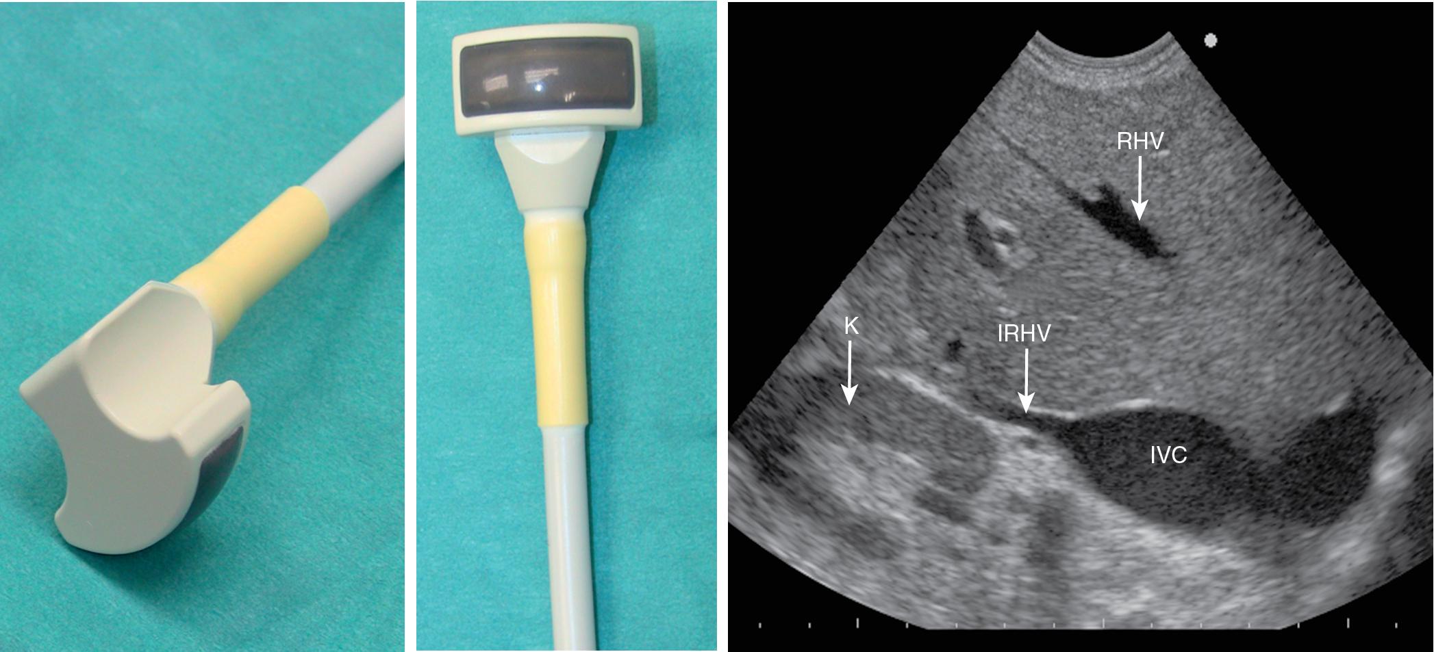 FIGURE 103.4, From left to right, the microconvex echoprobe, the scanning side of the probe, and the scanning area is shown. This wide-range frequency echoprobe (2–7 MHz) makes it possible in one scan to visualize the liver with a tumor, in which the right hepatic vein (RHV), an inferior right hepatic vein (IRHV), and the right kidney (K) are recognizable. IVC, Inferior vena cava.