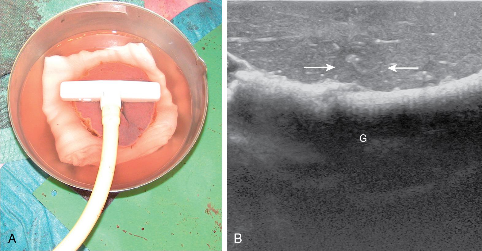 FIGURE 103.41, From left to right, the water-bath technique for checking the surgical specimen; the inclusion of the targeted nodule (arrows) is confirmed at intraoperative ultrasound (IOUS). G , Gauzes.