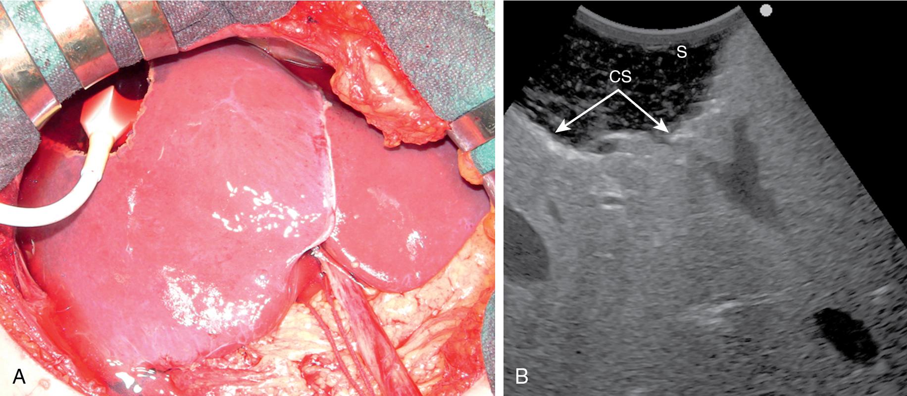 FIGURE 103.42, For further control, particularly if the inclusion of the lesion in the specimen is not confirmed, the cut surface (CS) filled with saline (S) can be explored with intraoperative ultrasound (IOUS).