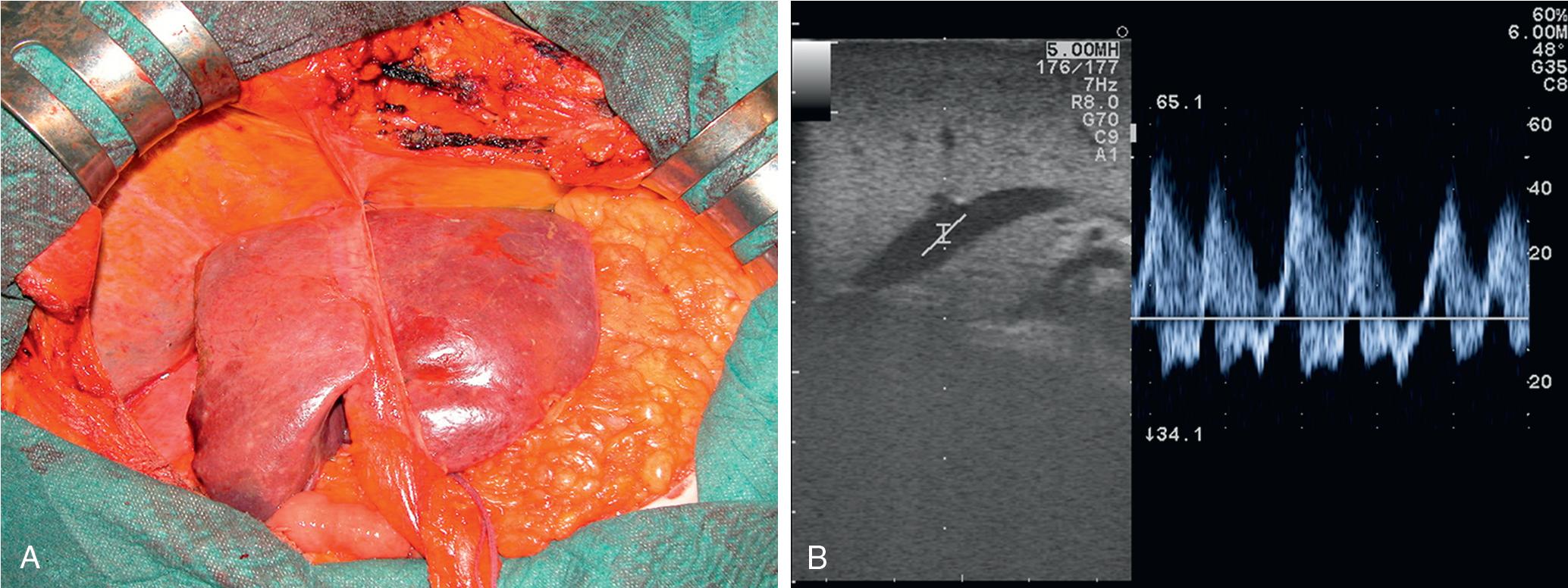 FIGURE 103.43, If a right hepatectomy is carried out (A), the proper repositioning of the remnant liver is performed using color Doppler to see whether the proper outflow is obtained with a triphasic wave pattern as shown (B).