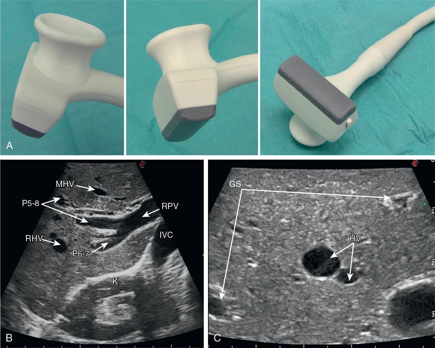 FIGURE 103.5, This intraoperative linear probe (A) (Esaote SpA, Genova, Italy) features a trapezoidal scanning area (B) mimicking the scanning window of a convex probe: This probe combines the stability of a linear transducer, the wideness of the scanning window of a convex probe, and the resolution of a high-frequency transducer. It was designed also for allowing ultrasound-guided compression maneuvers. Indeed, its shape allows ergonomic placement of the surgeon’s finger (arrows) to facilitate handling. GS , Glissonean sheath; HV , hepatic vein; K , Kidney; IVC , inferior vena cava; MHV , middle hepatic vein; P5-8 , portal branch to segments V and VIII; P6-7, portal branch to segments VI and VII; RHV, right hepatic vein.