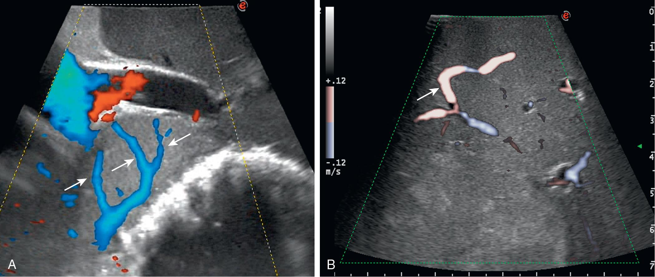 FIGURE 103.6, The appearance of the liver, once the exploration is carried out under the color flow intraoperative ultrasound (CF-IOUS) mode, a more sensitive modality compared with color Doppler for analyzing the blood flow. This increases the sensitivity and allows precise mapping of the slow-motion flow as shown in these pictures; tiny vessels (arrows) are clearly depicted.