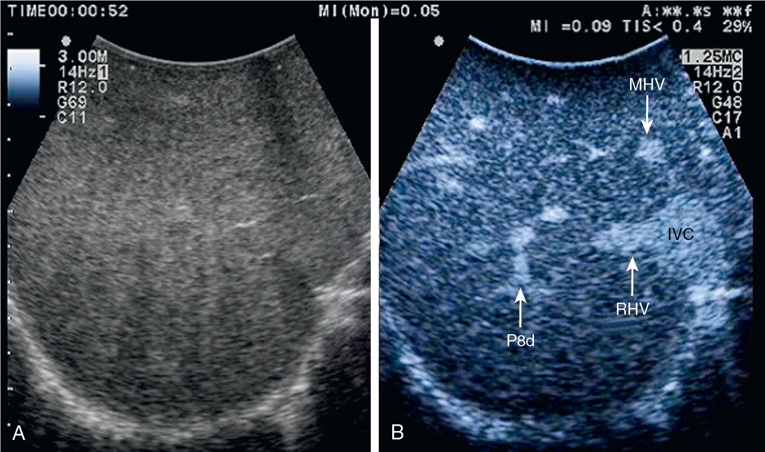 FIGURE 103.7, The appearance of the liver at intraoperative ultrasound (IOUS) using contrast enhancement.