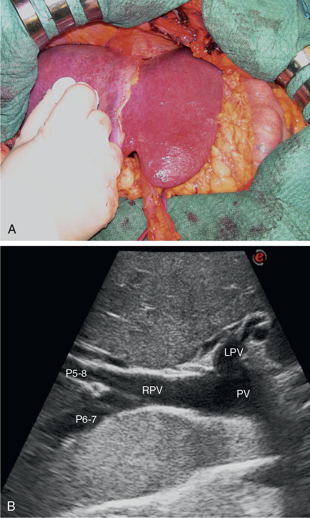 FIGURE 103.9, A, Liver exposed for initial exploration, once the falciform ligament has been cut; the surgeon is handling a probe. B , Typical branching pattern of the portal branches with the portal branch to right anterior section (P5-8) and to the right posterior section (P6-7) originating from the right portal vein (RPV). LPV , Left portal vein; PV, portal vein.