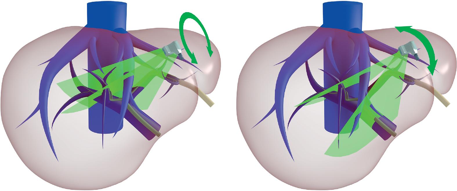 FIGURE 103.10, In these two schemas are shown the axis along which the probe is moved for initial liver exploration carried out by following Glissonean sheaths and hepatic veins.