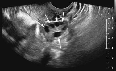 F igure 24-1, Normal ovary. Longitudinal transvaginal image shows an ovary with peripheral follicles (arrows) .