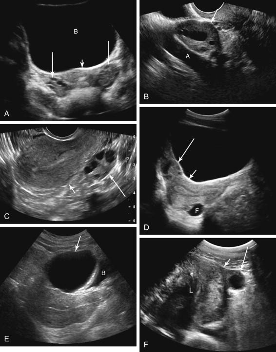 F igure 24-2, Ovarian locations. A, Transverse transabdominal image demonstrates the ovaries (long arrows) lateral to the uterus (short arrow) . B, Longitudinal transvaginal image angled to the left shows the ovary (arrow) anterior to the internal iliac artery (A). C, Midline longitudinal transvaginal scan shows the left ovary (long arrow) in the cul-de-sac, posterior to the uterus (short arrow) . D, Midline longitudinal transabdominal scan depicts the right ovary (long arrow) superior to the uterus (short arrow) . The left ovary is posterior to the uterus and contains a dominant follicle (F). E, Midline longitudinal transabdominal scan shows a cystic mass (arrow) corresponding to a serous cystadenoma in the right ovary anterior to the uterus, resembling the urinary bladder. Note a small amount of urine in the nearly empty bladder (B), inferior to the cystic mass. F, Transverse transabdominal scan shows the left ovary (long arrow) high in the pelvis lateral to the uterus (short arrow) secondary to uterine enlargement by a large shadowing leiomyoma. B, Bladder; L, leiomyoma.