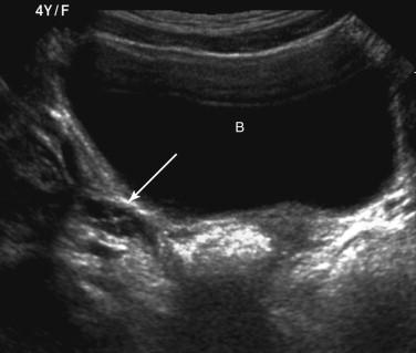 F igure 24-3, Normal ovary in a child. Transverse transabdominal image of the right ovary (arrow) of a 4-year-old girl shows follicles. B, Bladder.