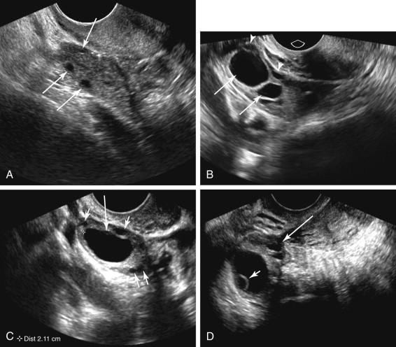 F igure 24-4, Changes in the ovary during the menstrual cycle. A, Transvaginal image of the right ovary during the early proliferative phase shows several very small follicles (arrows) . B, Transvaginal image of the ovary late in the proliferative phase demonstrates two prominent follicles (long arrows) as well as a few smaller follicles (arrowheads) . C, Transvaginal image of the ovary as ovulation approaches shows a dominant follicle (long arrow) measuring 2.1 cm and several smaller follicles (short arrows) . D, Cumulus oophorus. Transvaginal scan of the right ovary (long arrow) reveals a cystic structure corresponding to the cumulus oophorus (short arrow) along the inner margin of the dominant follicle, resulting in a cyst-within-a-cyst appearance.