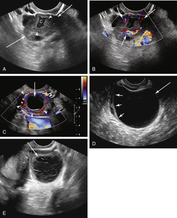 F igure 24-5, Corpus luteum. A, Longitudinal transvaginal image of the right ovary (long arrows) shows the corpus luteum as a rounded structure with a thick wall (arrowheads) and a central irregularly shaped cystic component (C). B, Color Doppler image of the same ovary as in image A reveals a peripheral rim of blood flow (arrows) surrounding the corpus luteum. C, Transvaginal image with color Doppler shows a prominent cystic component (long arrow) in the corpus luteum as well as a peripheral rim of blood flow (arrowheads) . D, Transvaginal ultrasound image shows a corpus luteal cyst (long arrow) measuring approximately 5.5 cm in diameter. Note the small amount of compressed ovarian tissue (short arrows) with follicles at the periphery of the cyst. E, Transvaginal ultrasound image of the ovary shows a hemorrhagic corpus luteal cyst (arrow) . Note the presence of fine linear strands in the cyst, an ultrasound pattern often attributable to intracyst hemorrhage.