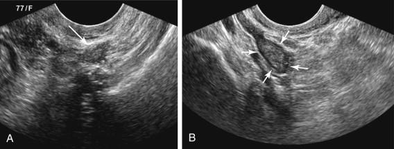 F igure 24-6, Postmenopausal ovary. A, Transvaginal image of the ovary (arrow) in a 77-year-old postmenopausal woman. The ovary is difficult to visualize due to its small size and absence of follicles. B, Transvaginal ultrasound image of the ovary in a 59-year-old postmenopausal woman shows a hypoechoic rim around the periphery of the ovary (arrows) , aiding in identifying the ovary.