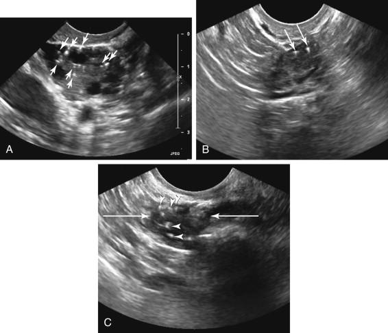 F igure 24-7, Punctate echogenic ovarian foci. A, Transvaginal ultrasound image of the ovary reveals multiple punctate echogenic foci (arrows) . Tiny echogenic foci are frequently seen in the ovaries and are not considered clinically significant. B, Transvaginal image shows echogenic ovarian foci with comet-tail artifact (arrows) . C, Identification of the ovary (long arrows) in an 80-year-old postmenopausal woman is facilitated by visualization of intraovarian echogenic foci (arrowheads) .