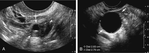 F igure 24-8, Management of simple ovarian cysts in postmenopausal woman: recommendations of the Society of Radiologists in Ultrasound Consensus Conference. A, A 5 mm simple cyst (long arrow) in the ovary (arrowheads) of a 56-year-old postmenopausal woman is not considered clinically important due to its simple appearance and subcentimeter size. No follow-up is recommended. B, A 2.8 cm simple cyst (cursors) in the ovary (arrows) of a 59-year-old postmenopausal woman. Annual follow-up is recommended because cyst size is between 1 and 7 cm.