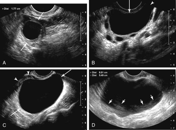 F igure 24-9, Management of simple ovarian cysts in women of reproductive age: recommendations of the Society of Radiologists in Ultrasound Consensus Conference. A, A 1.8 cm simple cyst (cursors) in the ovary (arrows) of a 32-year-old woman is considered a normal finding because it is smaller than 3 cm. B, A 3.8 cm simple cyst (long arrow) in the ovary (arrowheads) of a 23-year-old woman. The cyst should be described in the report but according to the consensus statement, follow-up is not necessary because it is a simple cyst measuring less than 5 cm. C, A 5.7 cm simple ovarian cyst (long arrows) in a 30-year-old woman. Note the small amount of compressed ovarian tissue (arrowheads) at the periphery of the cyst. Annual follow-up is recommended because the cyst measures between 5 and 7 cm. D, An 8.5 cm adnexal cyst (cursors) in a 29-year-old woman. Surgical evaluation or further assessment with MRI is recommended for a cyst larger than 7 cm, because it is difficult to ensure the entire cyst wall has been imaged. In this example, artifact (short arrows) prevents visualization of portions of the cyst wall.