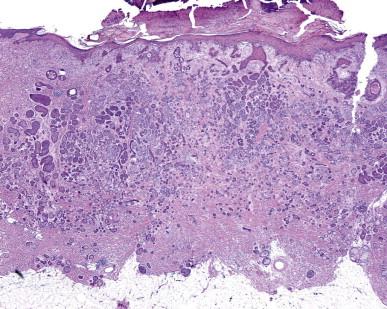 Figure 13.1, Microcystic adnexal carcinoma at low power, showing the solid nests of basaloid cells in the upper portions, which progressively diminish to strands and cords in the deeper portions of the lesion.