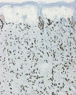 Figure 13.2, Immunohistochemical staining with CK7 best highlights the deeply infiltrative architecture of MACs.