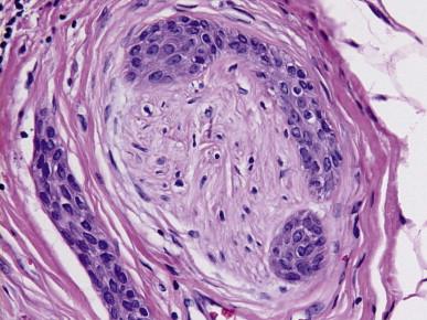 Figure 13.3, Strands of neoplastic cells are present within a nerve, which is a common finding in MACs.