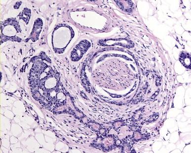 Figure 13.5, Perineural invasion, a feature consistently found in adenoid cystic carcinomas.