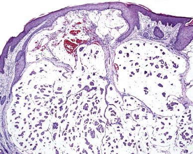 Figure 13.6, A low-power view of mucinous carcinoma showing large pools of mucin separated by thin fibrous septa containing collections of epithelial cells.