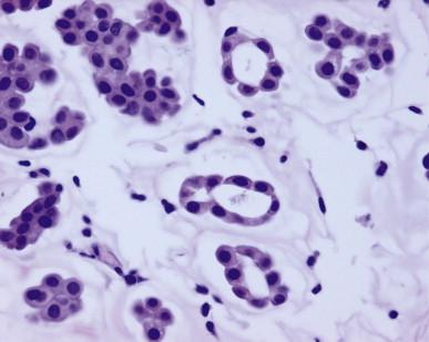 Figure 13.7, The lack of cellular pleomorphism in mucinous carcinoma can be appreciated at high power.