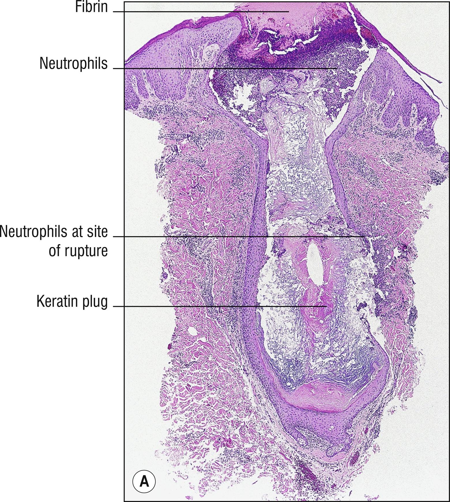 Fig. 10.1, A Ruptured comedo.