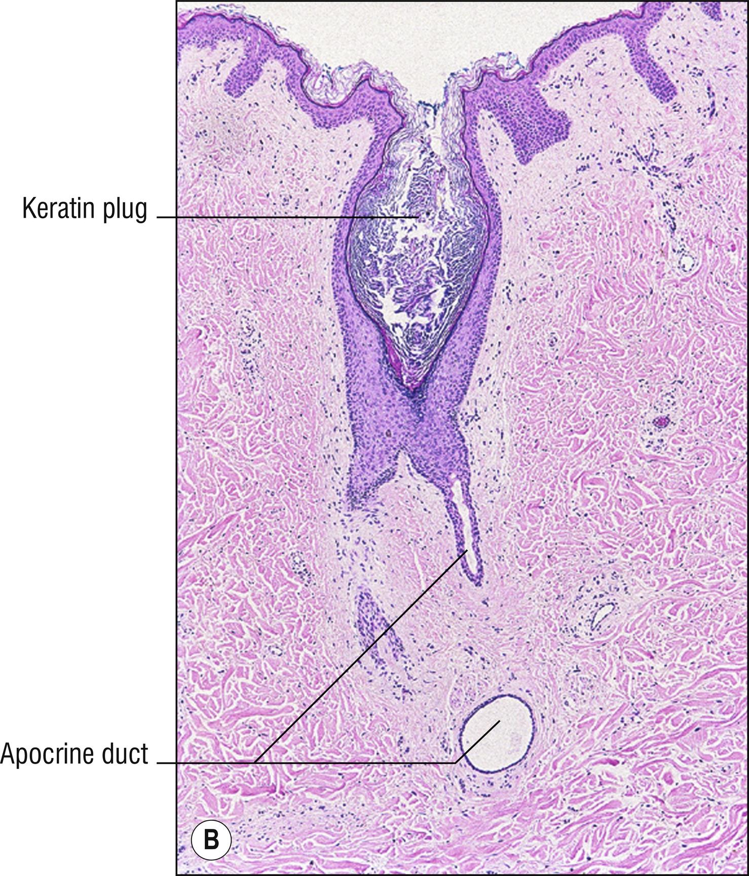 Fig. 10.1, B Hidradenitis suppurativa (low mag.).