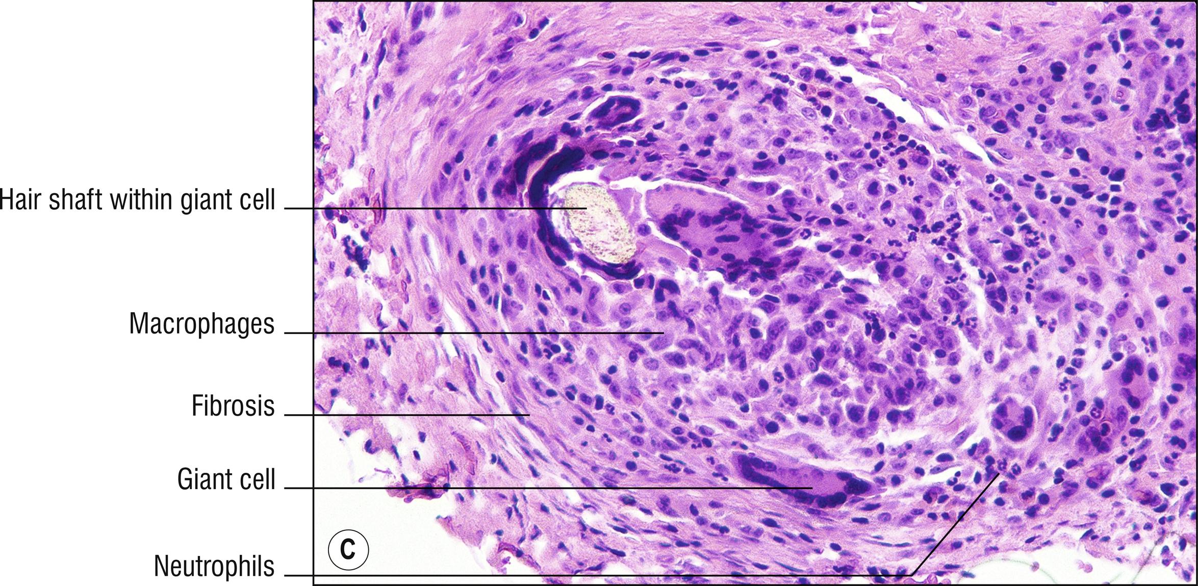 Fig. 10.1, C Hidradenitis suppurativa (high mag.).