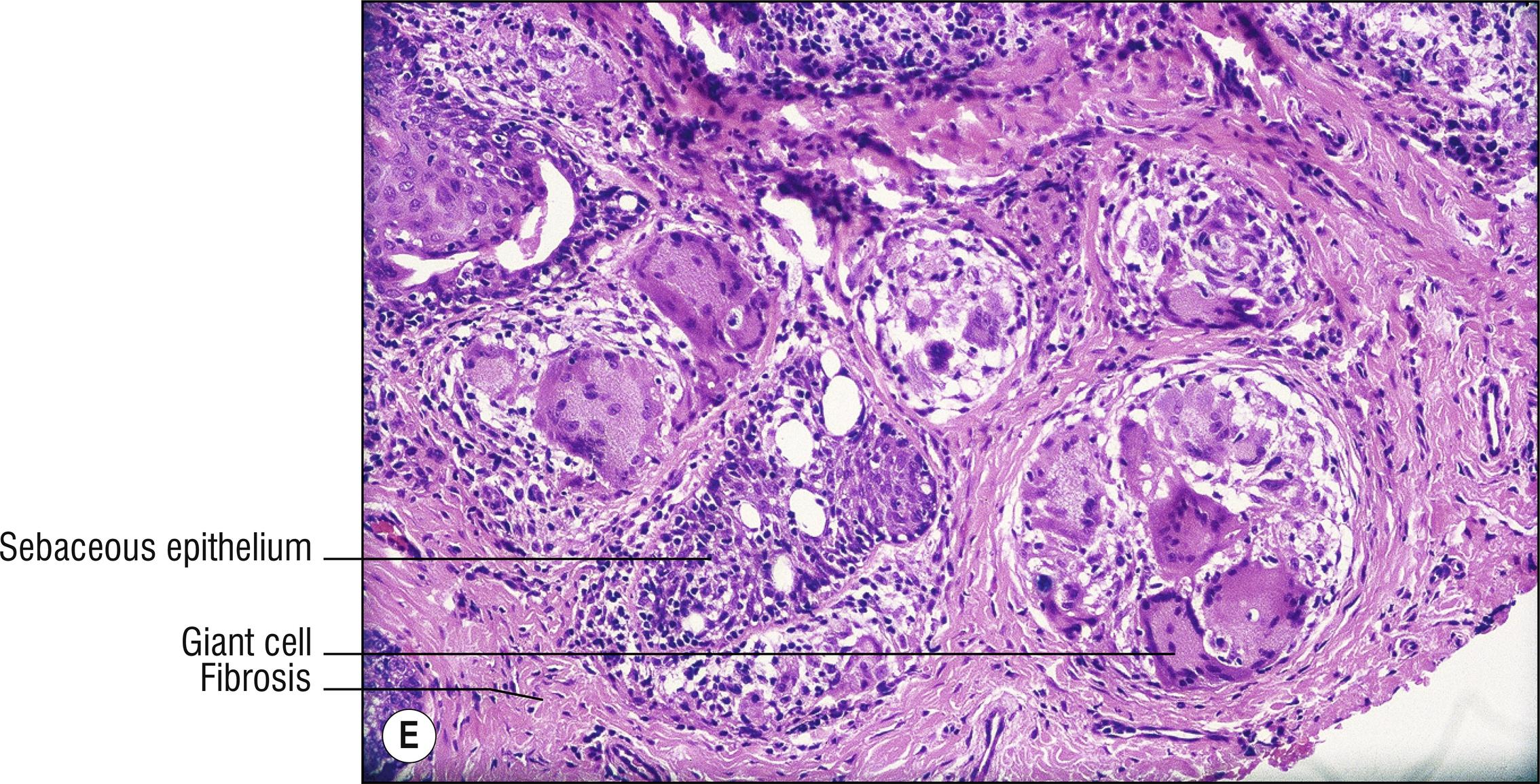 Fig. 10.1, E Chalazion.