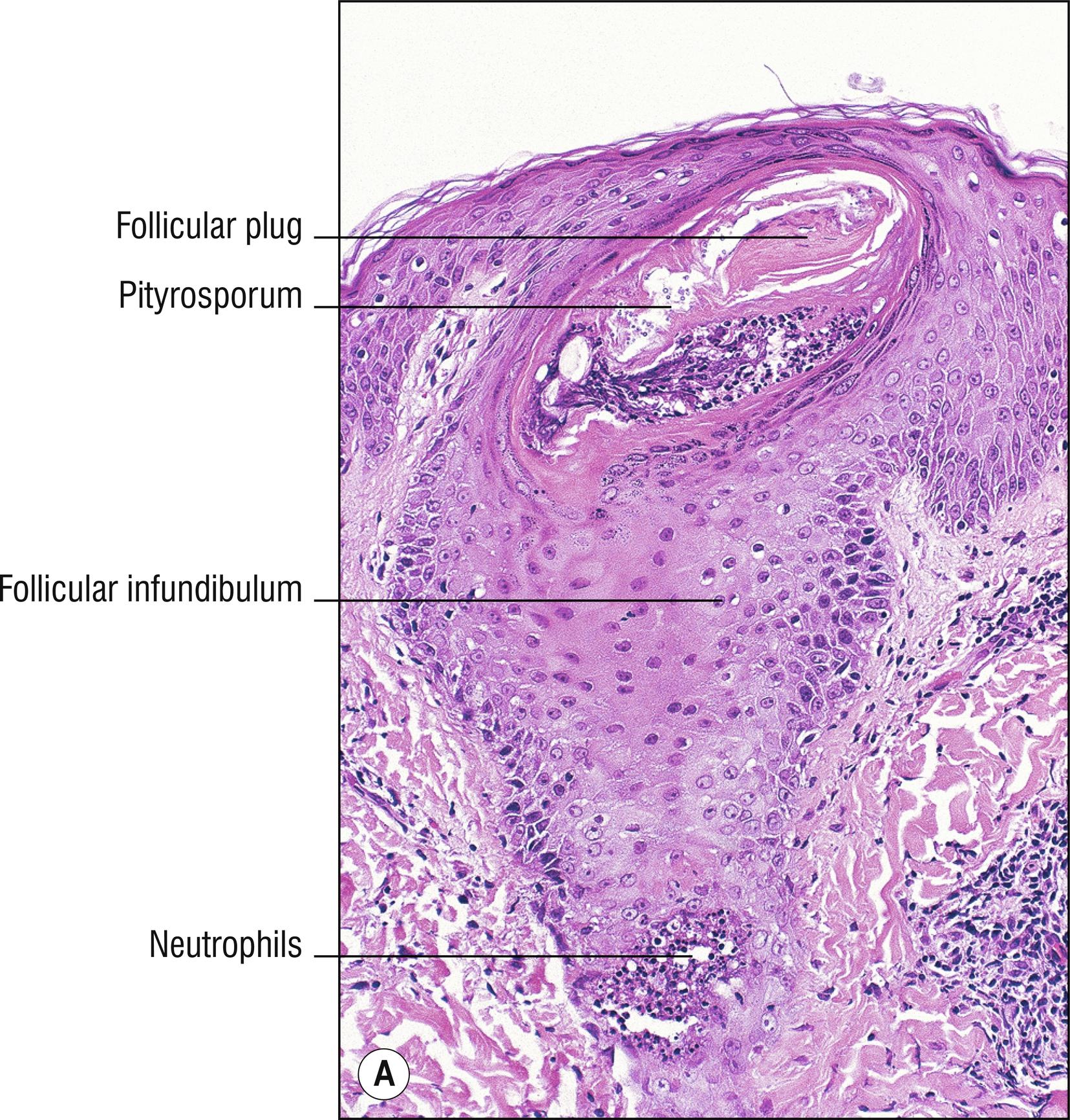 Fig. 10.2, A Folliculitis.