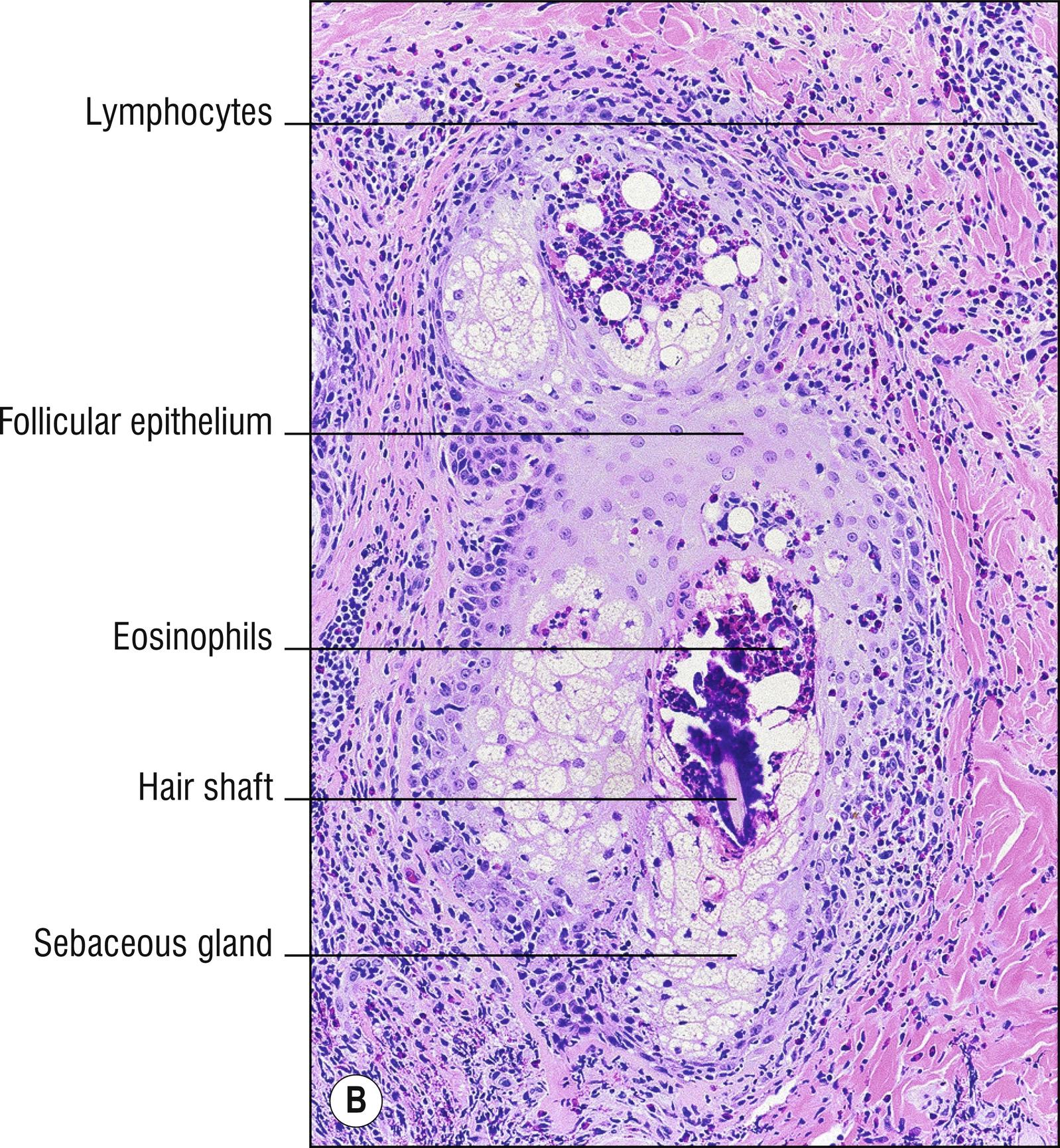 Fig. 10.2, B Eosinophilic folliculitis.