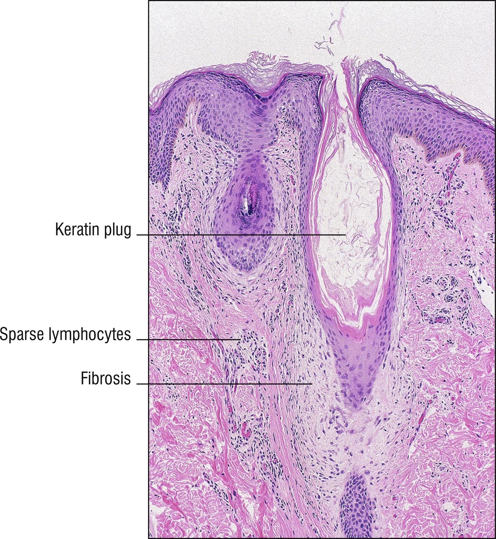 Fig. 10.5, Keratosis pilaris.