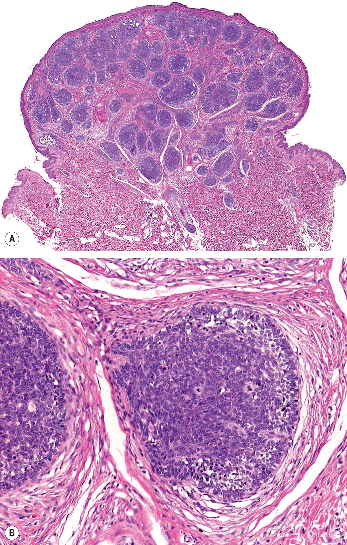 Fig. 111.13, Trichoepithelioma (trichoblastoma).