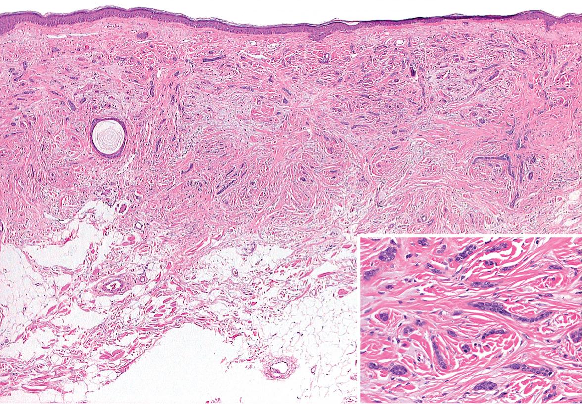 Fig. 111.14, Desmoplastic trichoepithelioma.