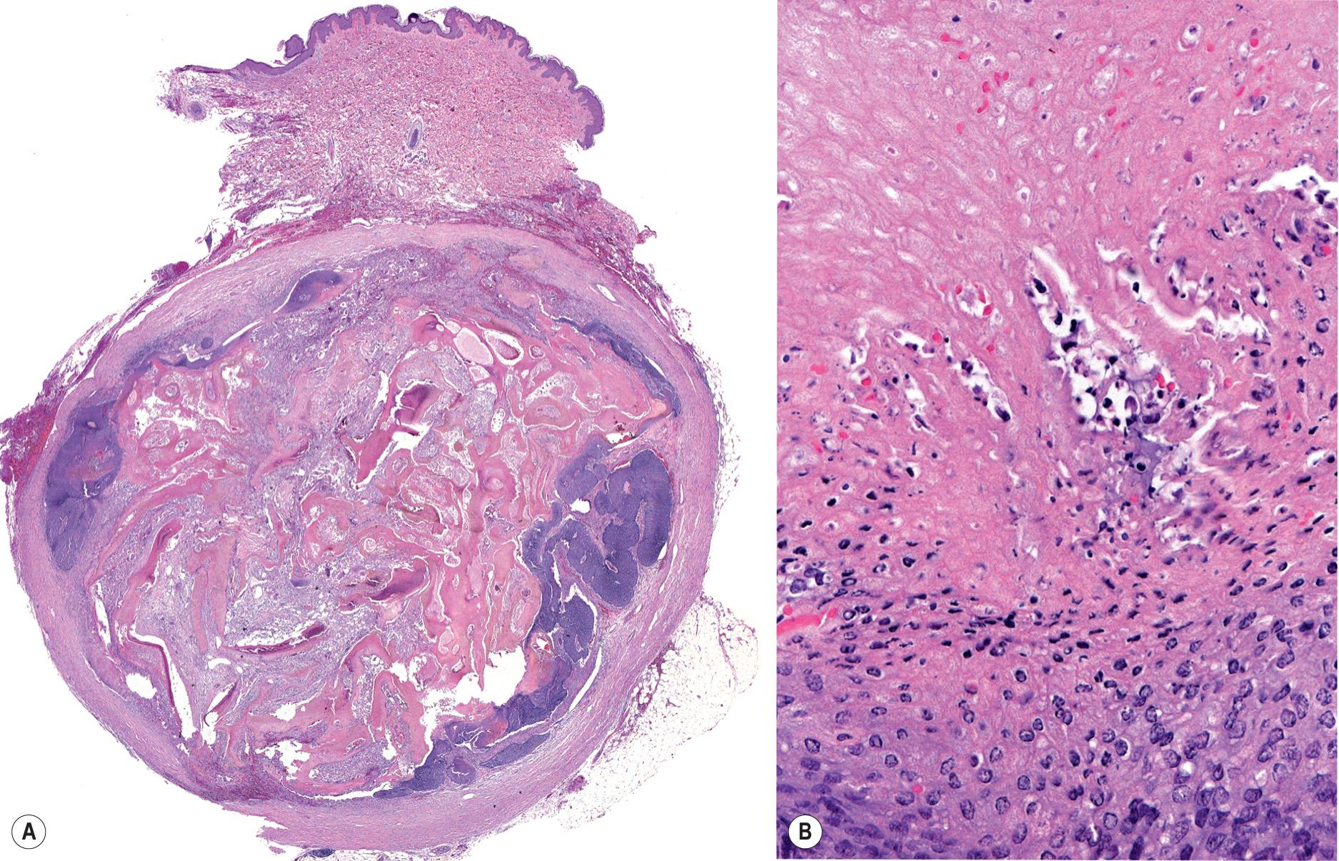 Fig. 111.16, Pilomatricoma.