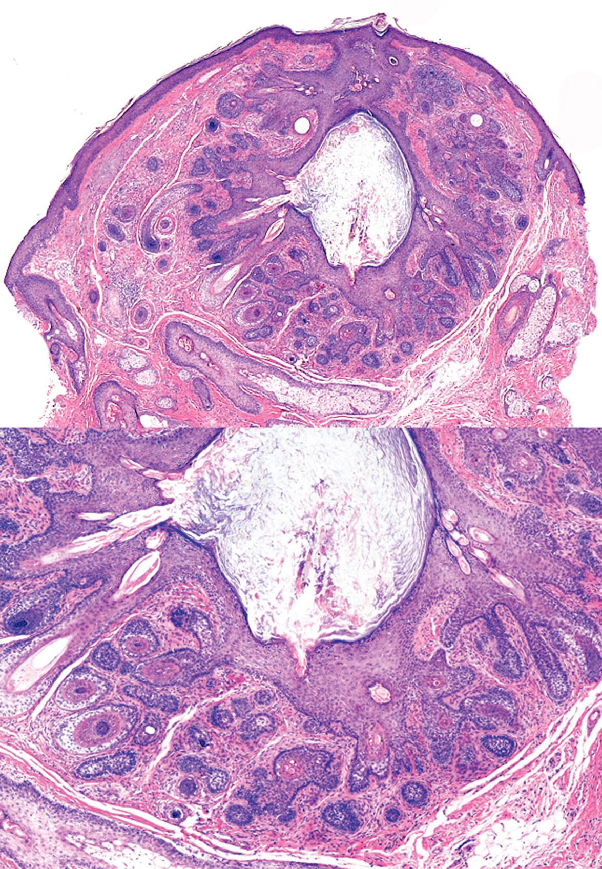 Fig. 111.3, Trichofolliculoma.