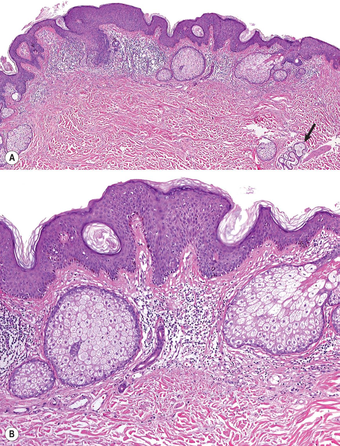 Fig. 111.8, Nevus sebaceus.