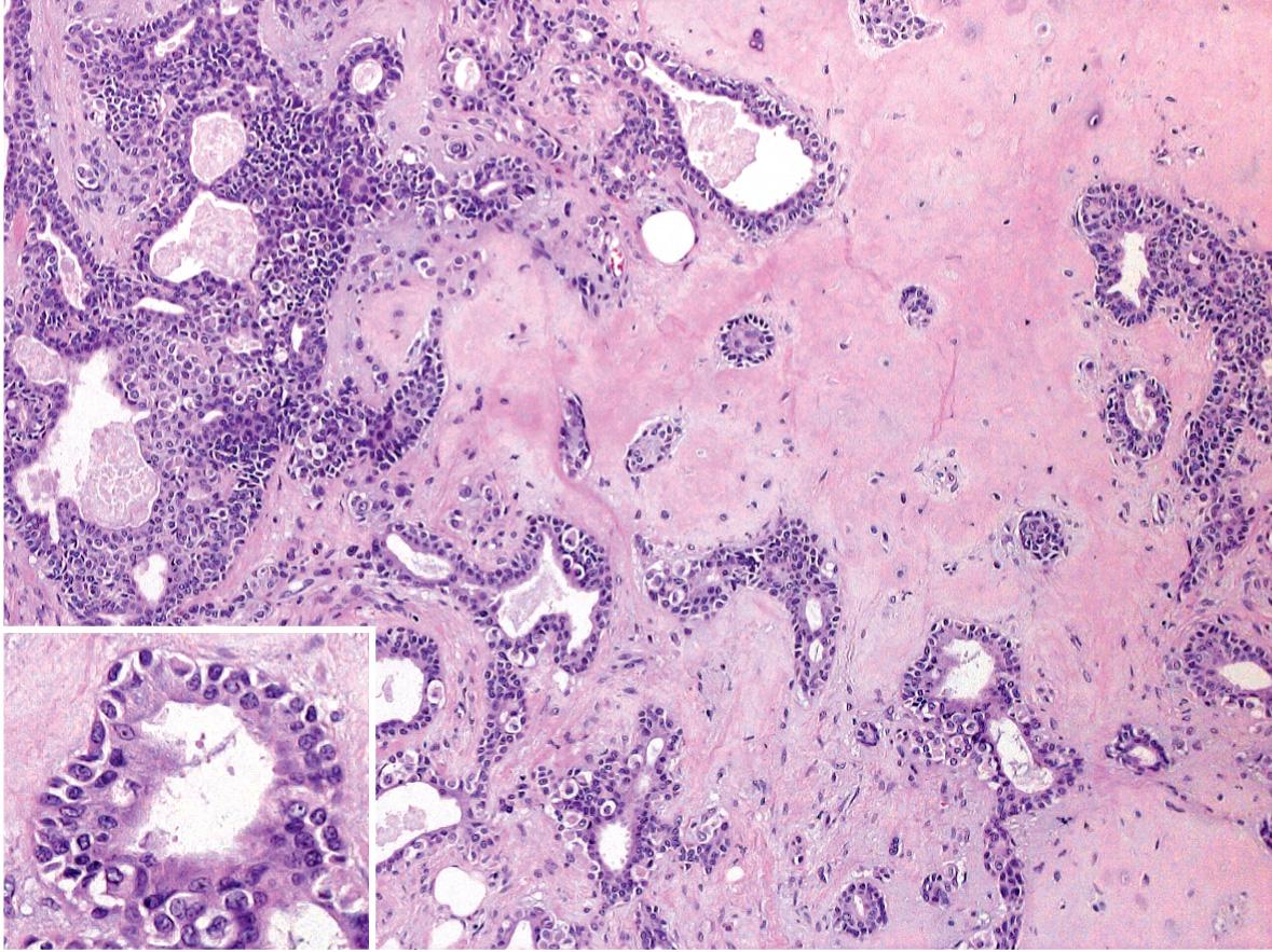 Fig. 111.10, Mixed tumor (chondroid syringoma) with overt apocrine differentiation.