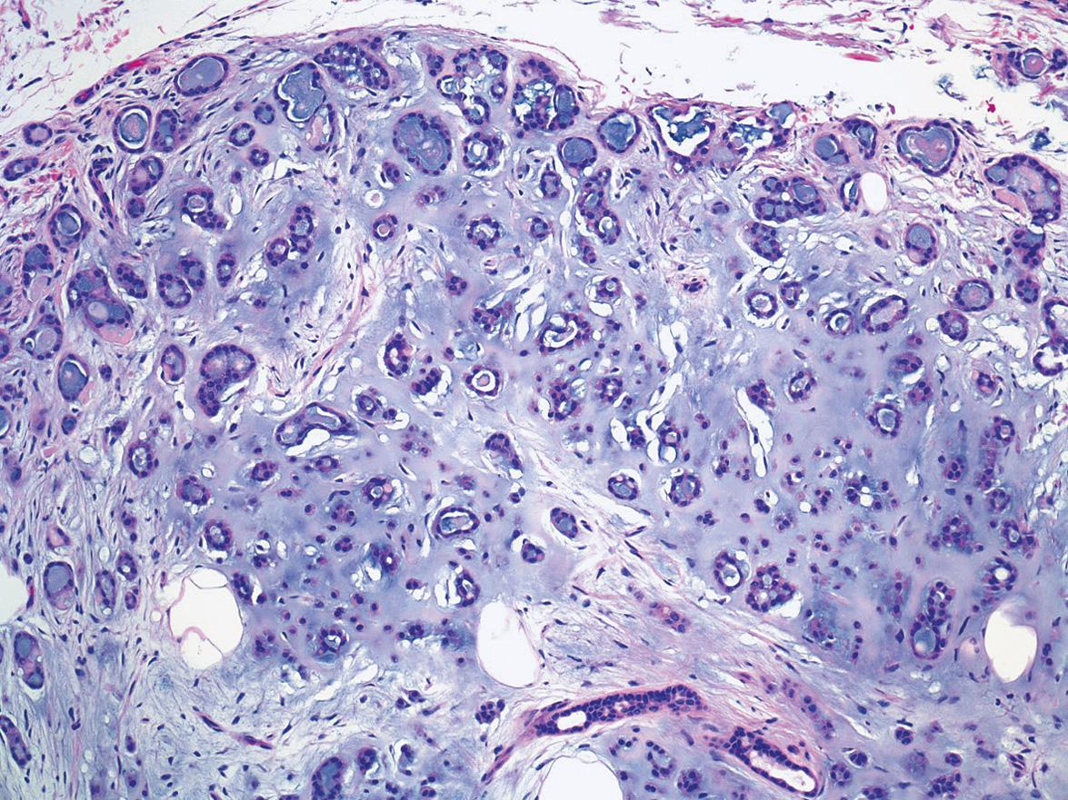 Fig. 111.11, Mixed tumor (chondroid syringoma) with ductal differentiation.