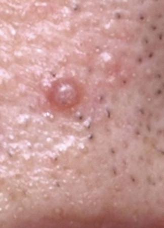 FIGURE 11-11, Tricholemmoma. A small skin-colored papule is present.