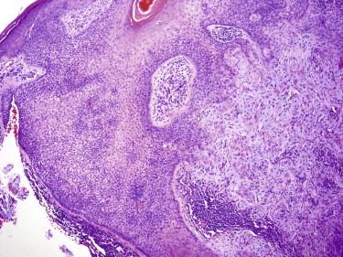 FIGURE 11-13, Desmoplastic tricholemmoma. A tumor with features of typical tricholemmoma at its periphery surrounds an irregular infiltrative epithelial growth associated with fibrosis.