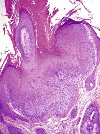 FIGURE 11-14, Trichilemmal wart. An exophytic verrucous growth pattern is associated with a lobular perifollicular clear cell proliferation at the base of the lesion.