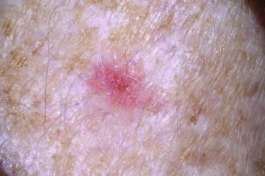 FIGURE 11-18, Basal cell carcinoma. Erythematous patch.