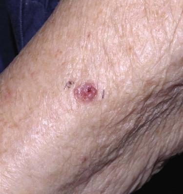 FIGURE 11-19, Basal cell carcinoma, erythematous nodule.