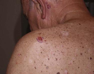 FIGURE 11-20, Basal cell carcinoma, ulcerated plaque.