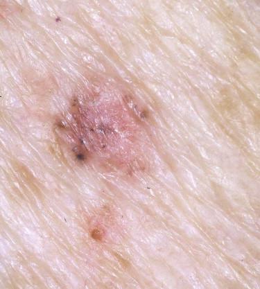 FIGURE 11-22, Pigmented basal cell carcinoma. A plaque is present with erythema and brown pigmentation.