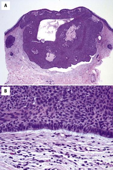 FIGURE 11-23, Basal cell carcinoma. A, A nodular or nodulocystic tumor composed of basaloid cells is seen. B, At the periphery of the tumor nodule, basaloid cells form a picket fence or “palisading” arrangement. A cleft separates tumor from dermal stroma. The cleft is filled with mucinous material.