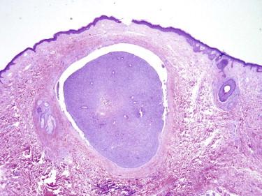 FIGURE 11-25, Basal cell carcinoma, nodular pattern. A solid tumor nodule is present in the dermis.